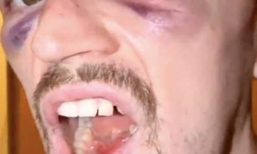 Хэрри Хардвик показал смещённую челюсть после TKO-поражения на UFC Fight Night 269